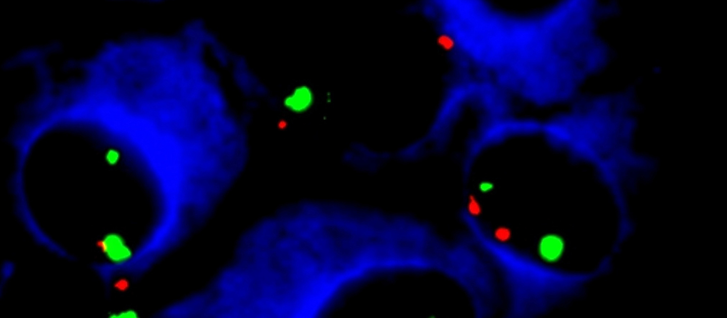 Magnified and coloured image of cells for Leukaemia talk